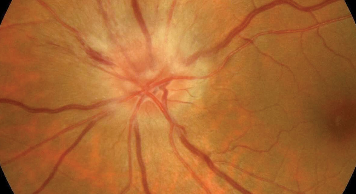 Non-Arteritic Anterior Ischemic Optic Neuropathy (NAION)