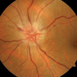 Non-Arteritic Anterior Ischemic Optic Neuropathy