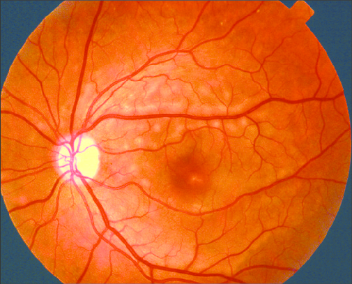 Acute Exudative Polymorphous Vitelliform Maculopathy