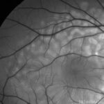 Acute Exudative Polymorphous Vitelliform Maculopathy