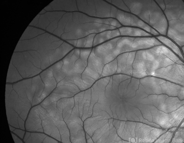 AEPVM: When Vision Blurs Without Warning