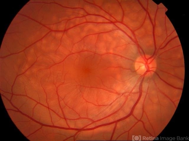 Acute Exudative Polymorphous Vitelliform Maculopathy
