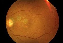 Ocular Gout