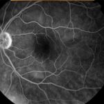 Paraneoplastic Retinopathy