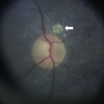 Ocular Gout