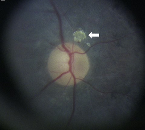 Ocular Gout