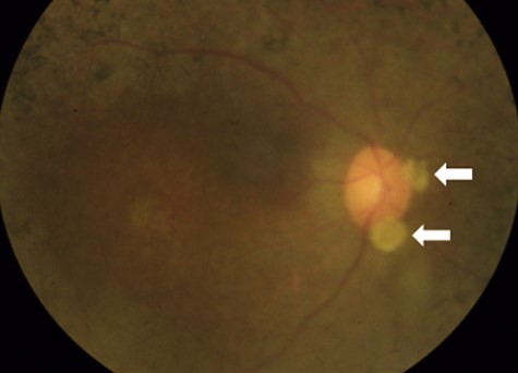 Ocular Gout