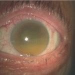 Phacolytic Glaucoma