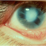 Peters Anomaly