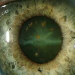 Siderosis Bulbi