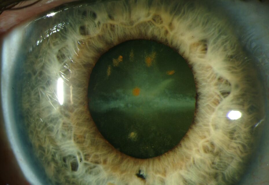 Siderosis Bulbi understanding: Iron Poisoning of the Eye