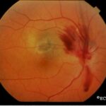 Radiation-induced Optic Neuropathy