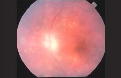 Parasitic Endophthalmitis