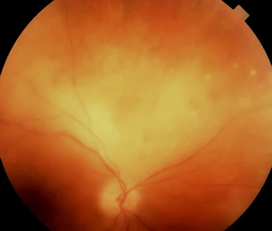 Ocular Syphilis