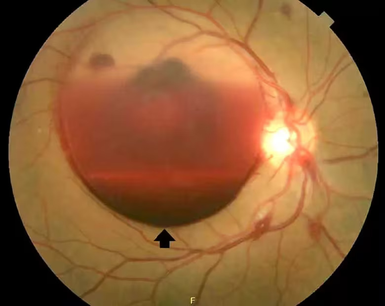 Ocular Syphilis