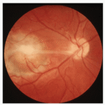 Parasitic Endophthalmitis
