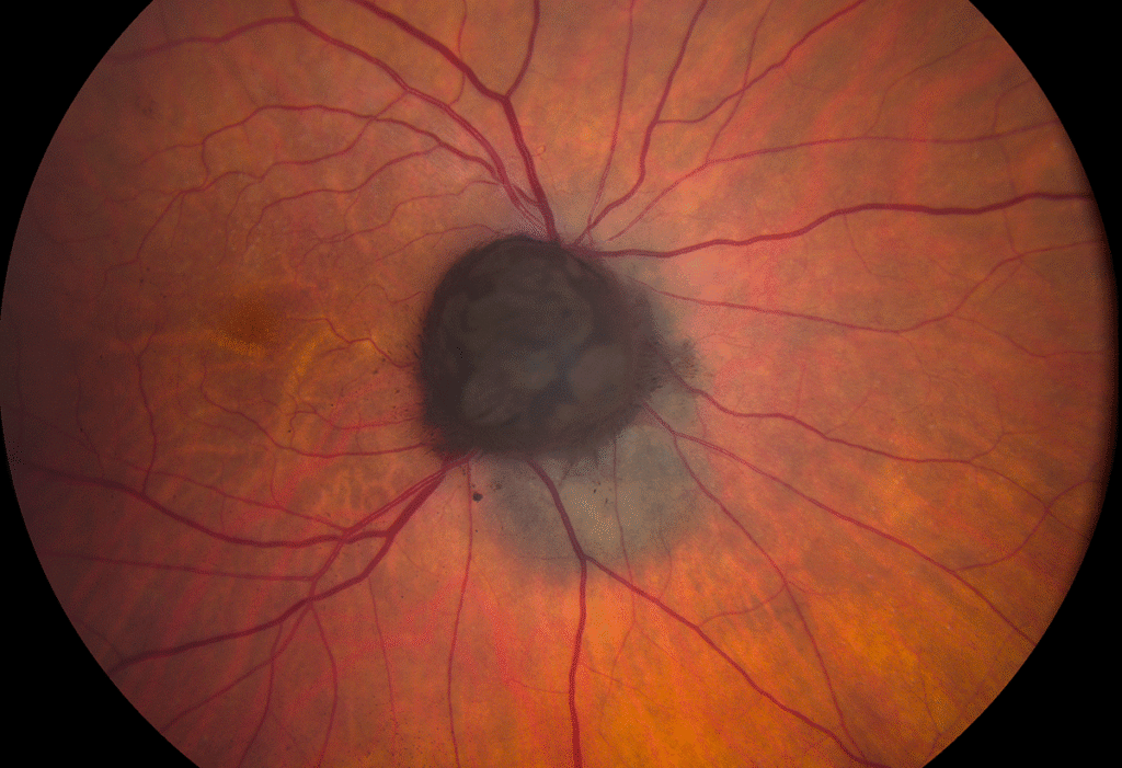 Choroidal Melanocytoma