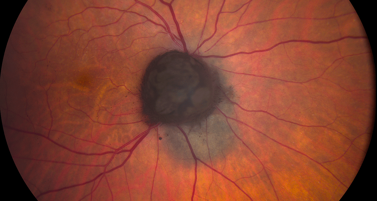 Choroidal Melanocytoma: Benign Tumor Mimics Melanoma