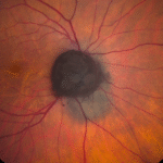 Choroidal Melanocytoma