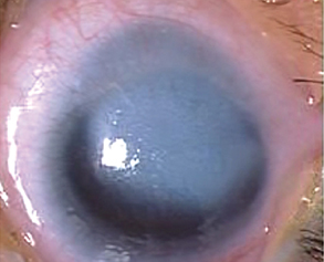 Peters Anomaly
