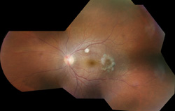 Endogenous Endophthalmitis