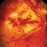 Endogenous Endophthalmitis