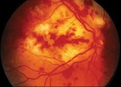 Endogenous Endophthalmitis