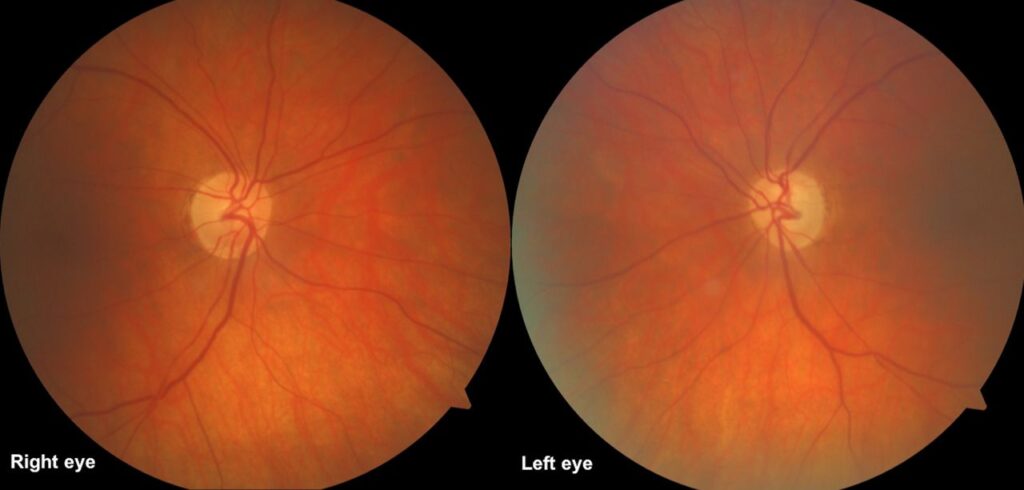 Radiation-induced Optic Neuropathy
