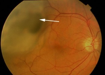 Choroidal Melanocytoma