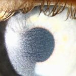Ocular Cystinosis