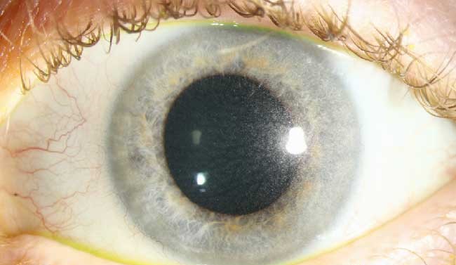 Ocular Cystinosis