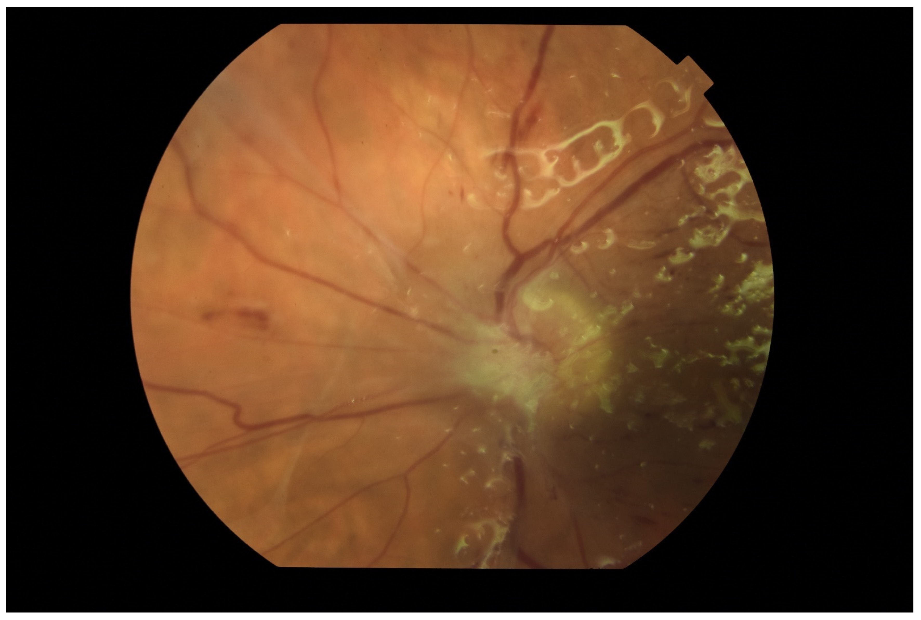 Endogenous Endophthalmitis