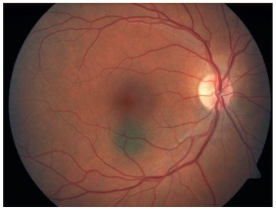Choroidal Melanocytoma