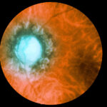 Ocular Syphilis