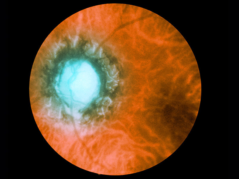Ocular Syphilis: The Great Retinal Imitator