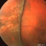 Bullous Retinoschisis