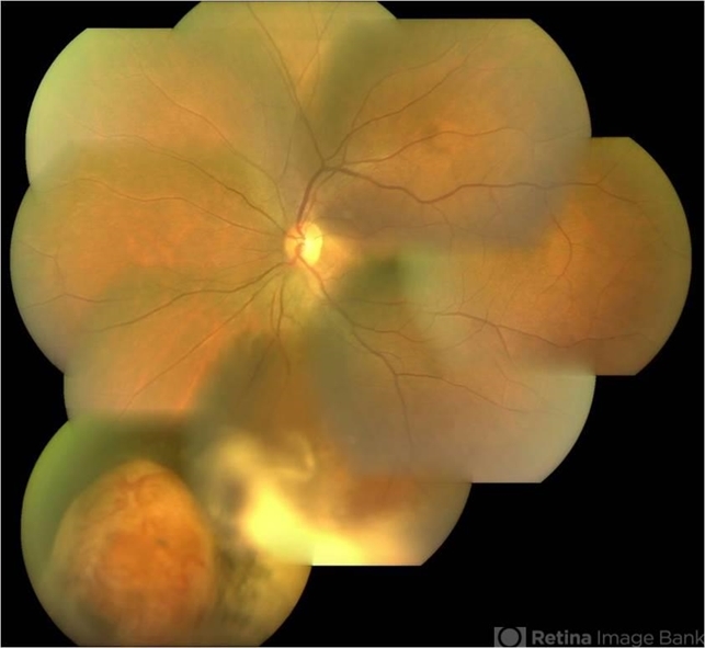 Retinal Vasoproliferative Tumor