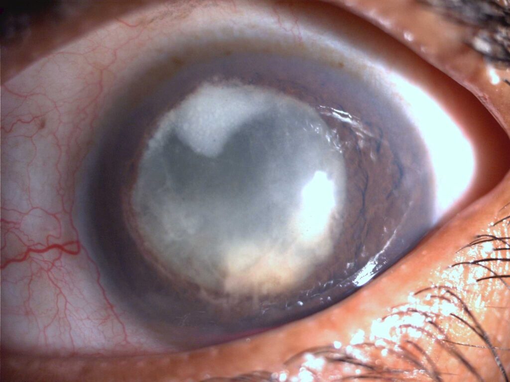 Postoperative Fungal Endophthalmitis