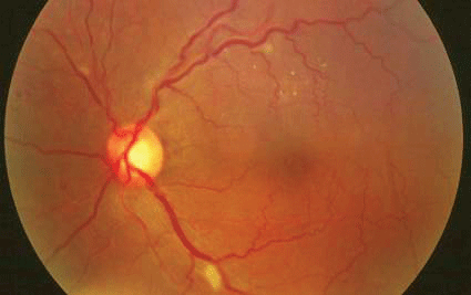 Ocular Complications of Systemic Lupus Erythematosus
