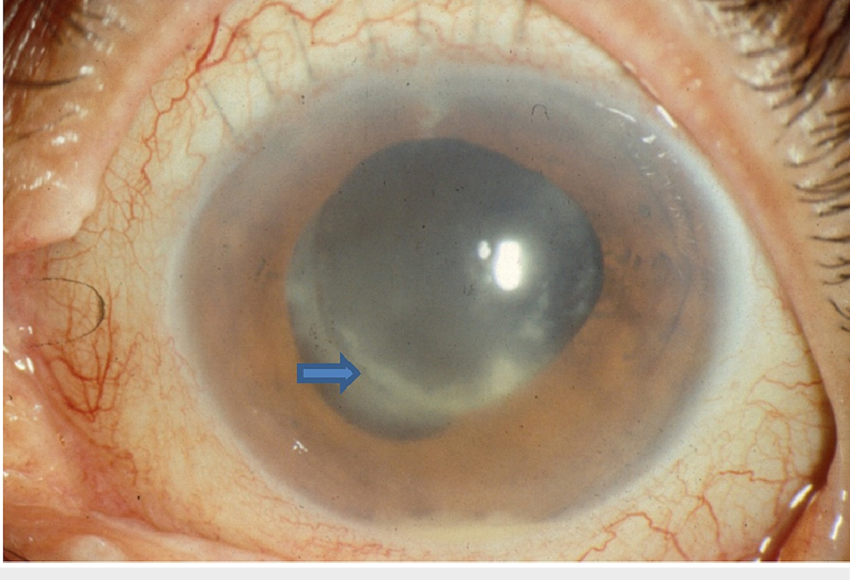 Postoperative Fungal Endophthalmitis