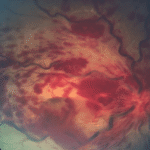 Ocular Complications of Systemic Lupus Erythematosus