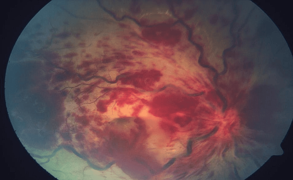 Ocular Complications of Systemic Lupus Erythematosus: A Comprehensive Overview
