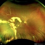Retinal Vasoproliferative Tumor