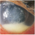 Postoperative Fungal Endophthalmitis