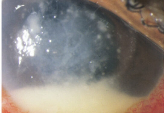 Postoperative Fungal Endophthalmitis Updates