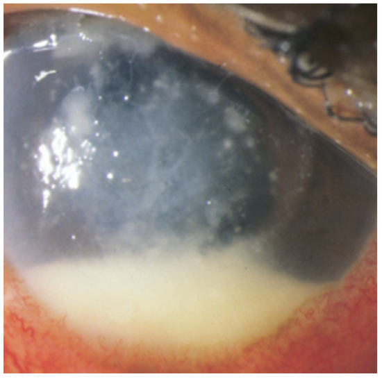 Postoperative Fungal Endophthalmitis Updates