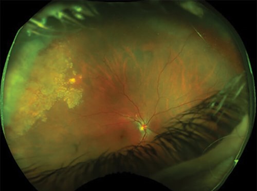Retinal Vasoproliferative Tumor