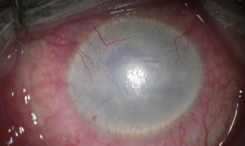 Pseudophakic Bullous Keratopathy