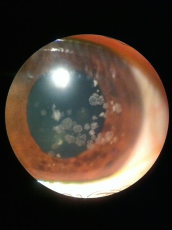 Corneal Stromal Dystrophy