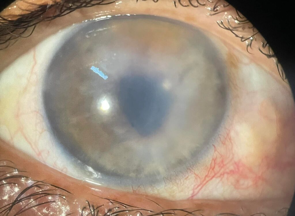 Pseudophakic Bullous Keratopathy